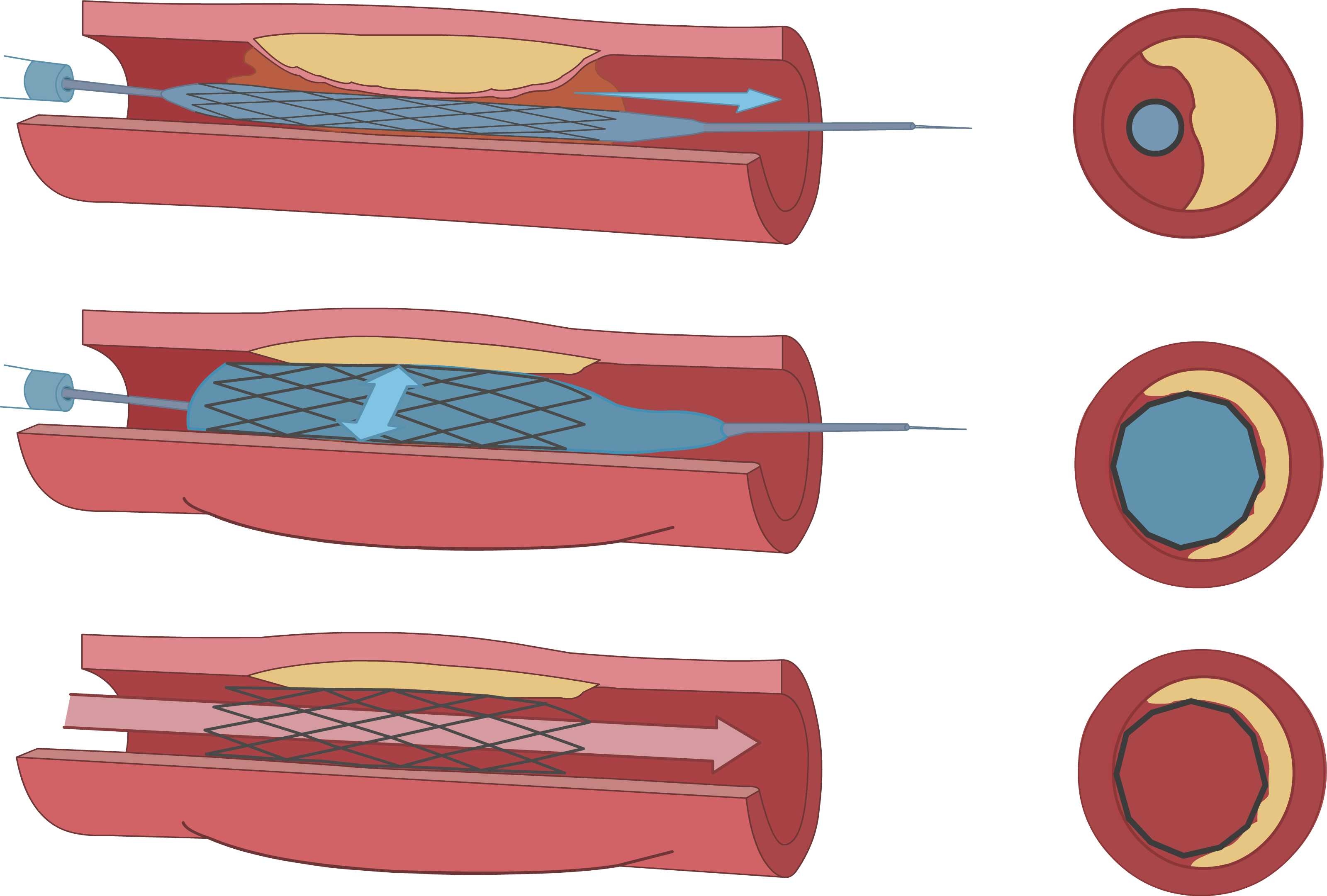 stent